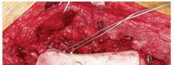 Illustration 11 for Allograft Prosthetic Composite: Mastering Proximal Femur Reconstruction