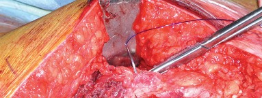 Illustration 12 for Mastering Direct Lateral Exposure for Revision Total Hip Success