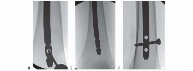 Illustration 24 for Pediatric Femoral Nailing: Targeting the Right aspect of the greater Trochanter