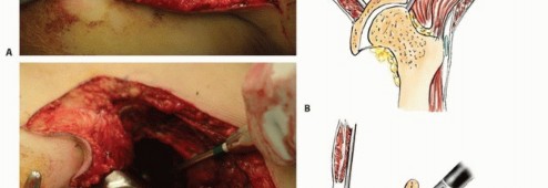 Illustration 32 for Pelvic Metastasis Surgery: A Component of the Utilitarian Approach