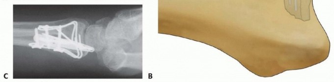 Illustration 44 for Fragment-Specific Fixation: Restore Carpal Facet Horizon