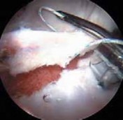 Illustration 20 for Resolving Femoral Head Neck Impingement: Arthroscopic FAI Solutions
