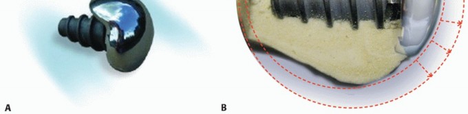 Illustration 12 for End Articular Cartilage Loss: Arthrosurface HemiCAP Resurfacing