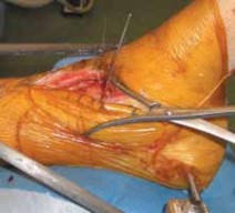 Illustration 45 for Optimizing ORIF for Tibial Plafond Fractures: A Modern Approach