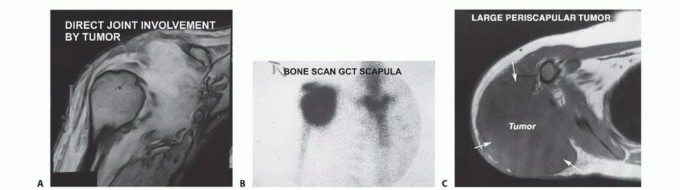 Illustration 3 for Mastering Total Scapular Resections: Reconstruction & Outcomes