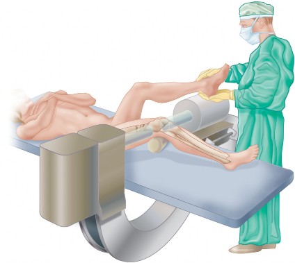 Illustration 11 for Mastering Periprosthetic Femoral Fractures Above Knee Arthroplasty
