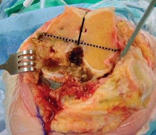 صورة طبية: مراجعة استبدال الركبة الجزئي الفاشل دليلك الشامل للعلاج الناجح في صنعاء
