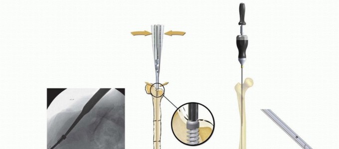 Illustration 26 for Less Pain, More Function: Fassier-Duval Nailing for Osteogenesis Imperfecta