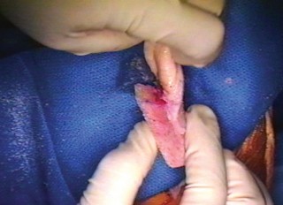 Illustration 13 for Extensor Reconstruction in Total Knee Arthroplasty: Essential Strategies