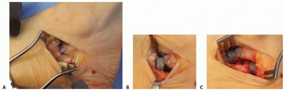 Illustration 25 for Lateral Column Lengthening: Relieve Flatfoot Pain & Correct Deformity