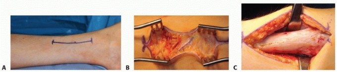 Illustration 4 for Distal Tibial Osteotomy: Fixing Varus & Valgus Ankle Alignment