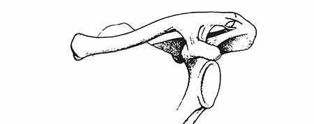 Illustration of clavicle fractures clavicle - Dr. Mohammed Hutaif