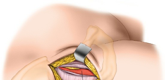 Illustration 85 for Unlocking Every Aspect of the Hip's Surgical Approaches