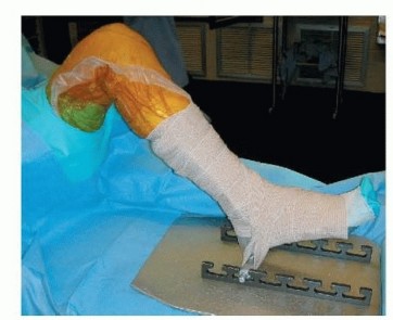 Illustration 7 for Correcting Stiffness in Revision TKA: Achieve Appropriate External Rotation