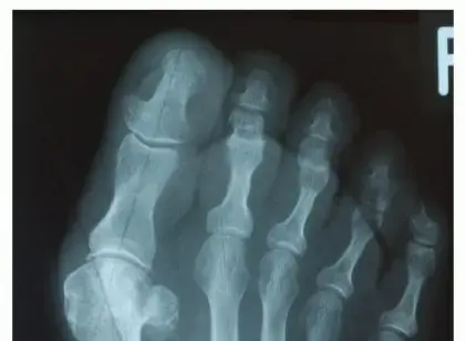 صورة توضيحية لـ إبهام القدم الأروح: دليل شامل للمرضى في اليمن والخليج العربي مع الأستاذ الدكتور محمد هطيف