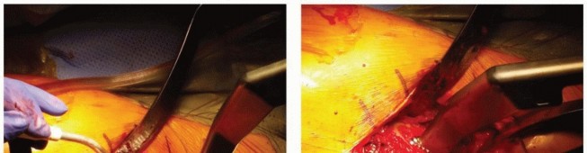 Illustration 11 for The Tapered Stem: Your Guide to Durable Cementless Hip Fixation