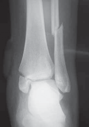 Illustration 9 for Optimal Fixation of the Ankle: Open Reduction & Internal Fixation