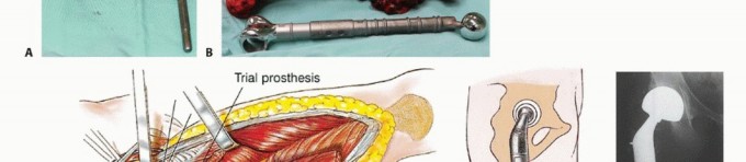 Illustration 37 for Beyond Amputation: Total Femur Resection with Endoprosthetics