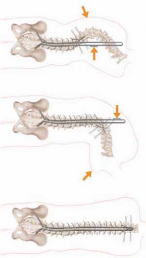 Illustration 7 for Optimizing Instrumentation for Neuromuscular Scoliosis