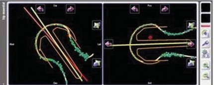 Illustration 37 for Minimizing Risks: Computer Navigation in Hip Resurfacing Arthroplasty