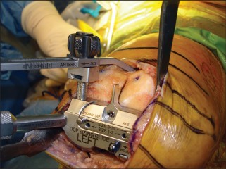 Illustration 11 for Minimal Incision Total Knee: Experience Faster Healing