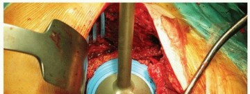 Illustration 7 for Cemented Acetabular Component: Achieving Optimal THA Stability
