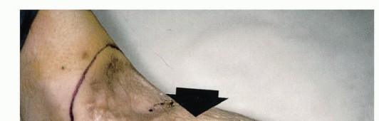 Illustration 2 for Below-Knee Amputation: Maximize Your Below-Knee Recovery & Function