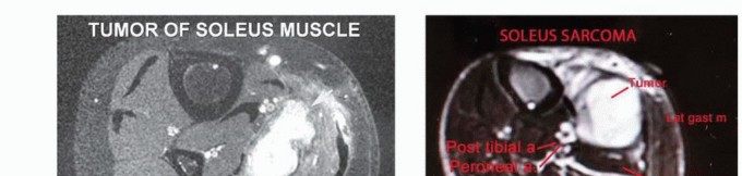 Illustration of heads of the gastrocnemius - Dr. Mohammed Hutaif