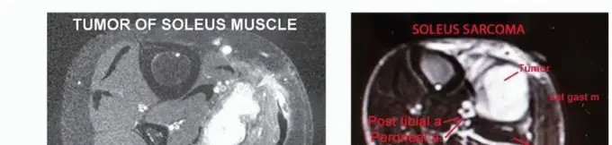 استئصال ورم العضلة النعلية: دليل شامل لحماية عضلة الساق والتعافي الكامل في صنعاء مع الأستاذ الدكتور محمد هطيف