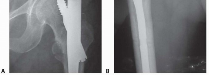 Illustration 34 for Achieve Optimal Femoral Head Fixation with Cephalomedullary Nailing