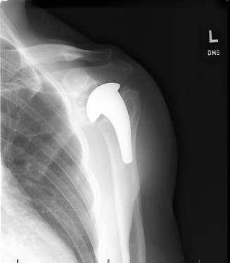 Periprosthetic Joint Infection After Shoulder Arthroplasty: Advanced Diagnosis & Management