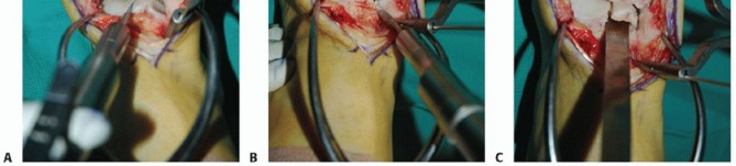 Illustration 30 for Unlock Healing: Medial Malleolar Osteotomy for Talus OLT Allografts