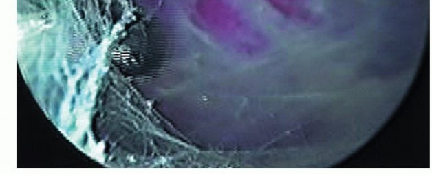 Illustration 19 for Is Your Dorsal Scapular Nerve Causing Snapping Scapula Pain?