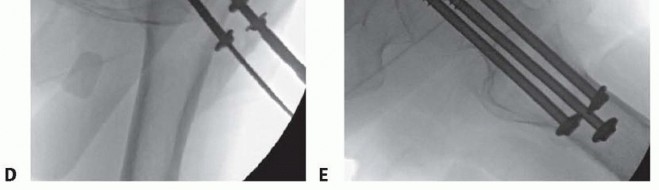 Illustration 13 for Is a Sliding Hip Screw Best for Your Femoral Neck Fracture?