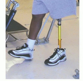 Illustration 35 for Mastering Hip Disarticulation: Through the Hip Joint Capsule