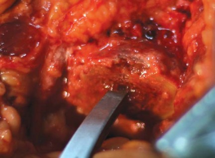 Illustration 14 for Considering METHA Short Stem? Discover Bone-Preserving THA