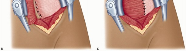 Illustration 30 for Finally Treat Recurrent Posterior Instability of the Shoulder