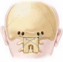 Illustration 12 for Cervical Fusion: The Line is Drawn for Lasting Stability