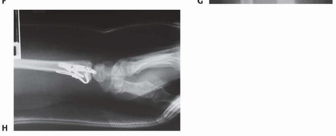 Illustration 29 for Fragment-Specific Fixation: Restore Carpal Facet Horizon