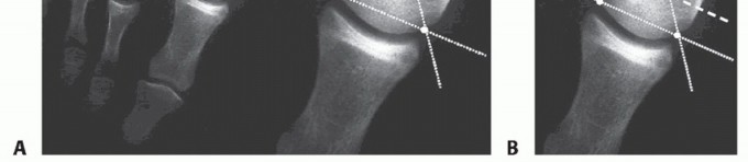 Illustration 6 for Mastering the Biplanar Distal Chevron for Effective Bunion Surgery