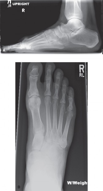 Illustration of degrees of dorsiflexion - Dr. Mohammed Hutaif
