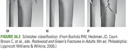 Tibial Plateau Fractures: Your Complete Guide to Diagnosis & Care