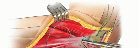 Illustration 24 for Radial Head Arthroplasty: Restoring Elbow Function & Stability