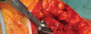 Illustration 14 for S-ROM: Inside the Technique of Modular Implant Design