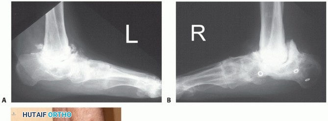Illustration 30 for Beyond Amputation: Circular Fixation for Infection of the Talus