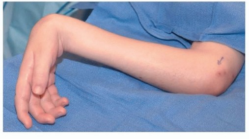 Solving Wrist Flexion Deformity: FCU Transfer Explained