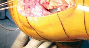 Illustration 26 for Minimally Invasive Subvastus: The Best Path to Quicker TKA Recovery