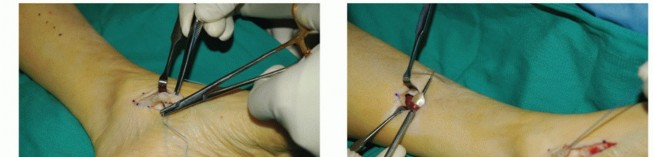 Illustration 27 for Restore Movement: Tendon Transfer for Common Peroneal Nerve Foot Drop