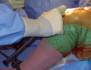 Illustration 15 for Cemented TKA Figure: Your Visual Guide to Surgical Success