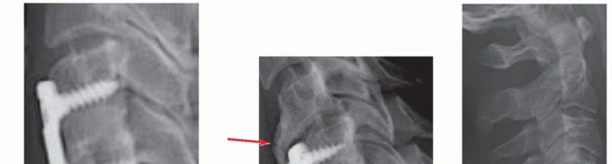 Illustration 23 for How ACDF Clears Your Posterior Disc Space for Lasting Relief